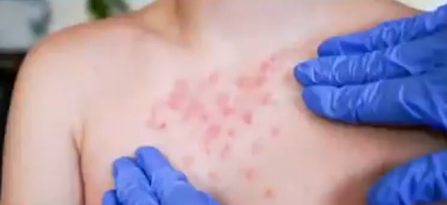 CDMX precisa edad del menor fallecido por sarampión