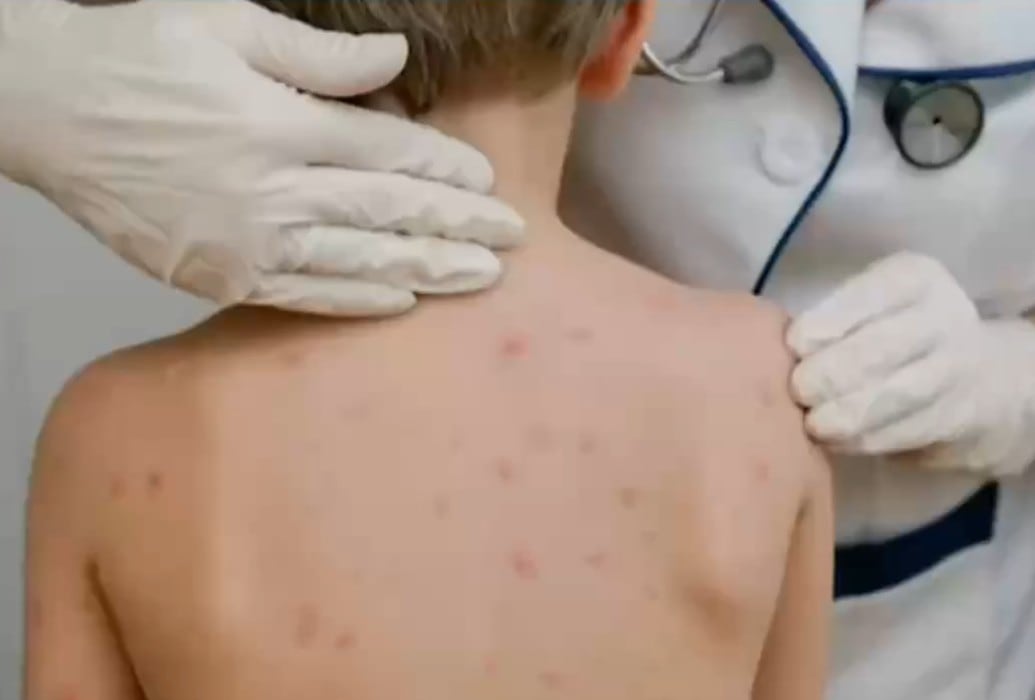 m7xdvdswobh6ndp5a4bkzb7isu CDMX precisa edad del menor fallecido por sarampión