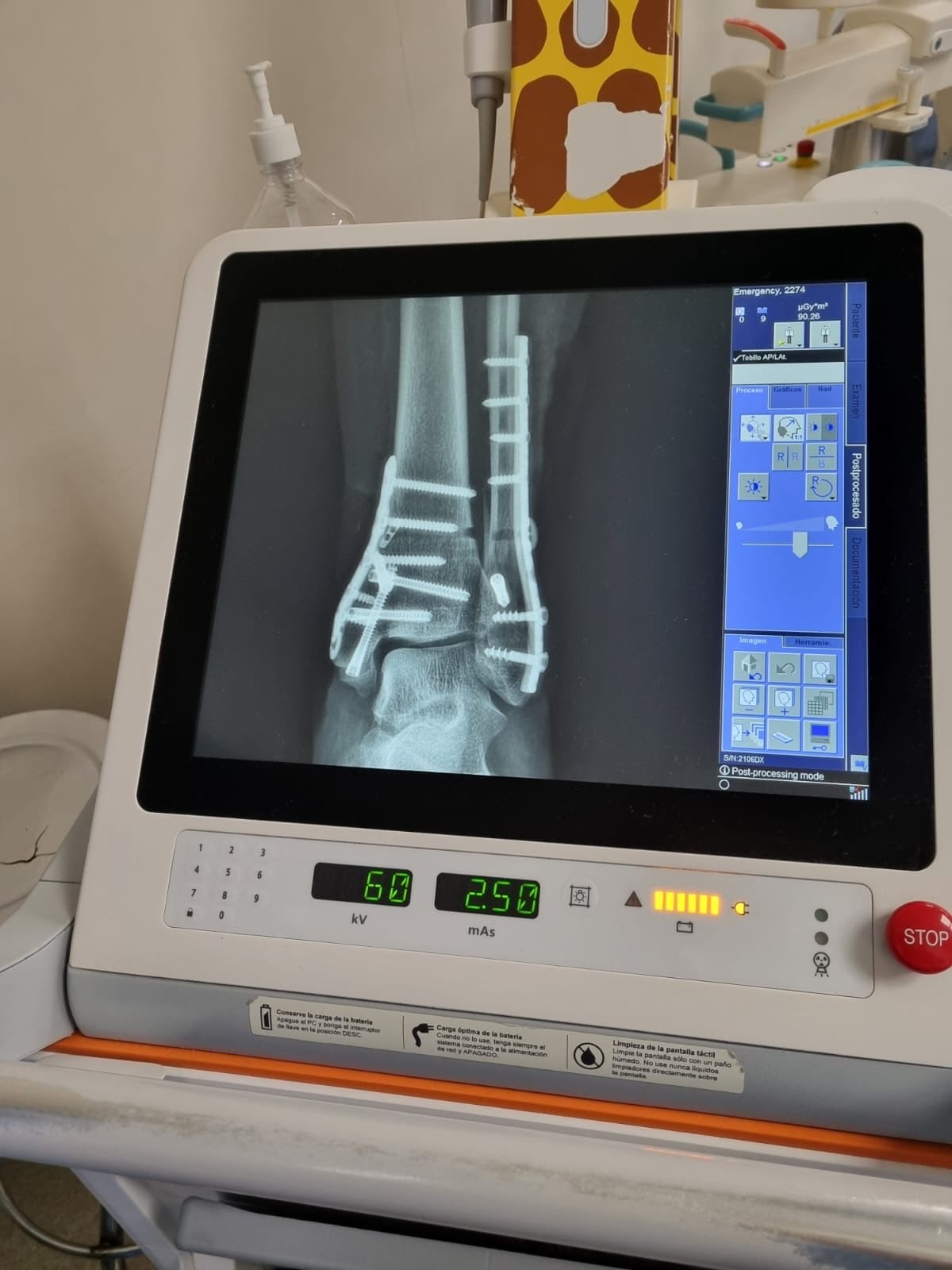 Madre muestra la fractura que le causó un juego infanil en Perisur.