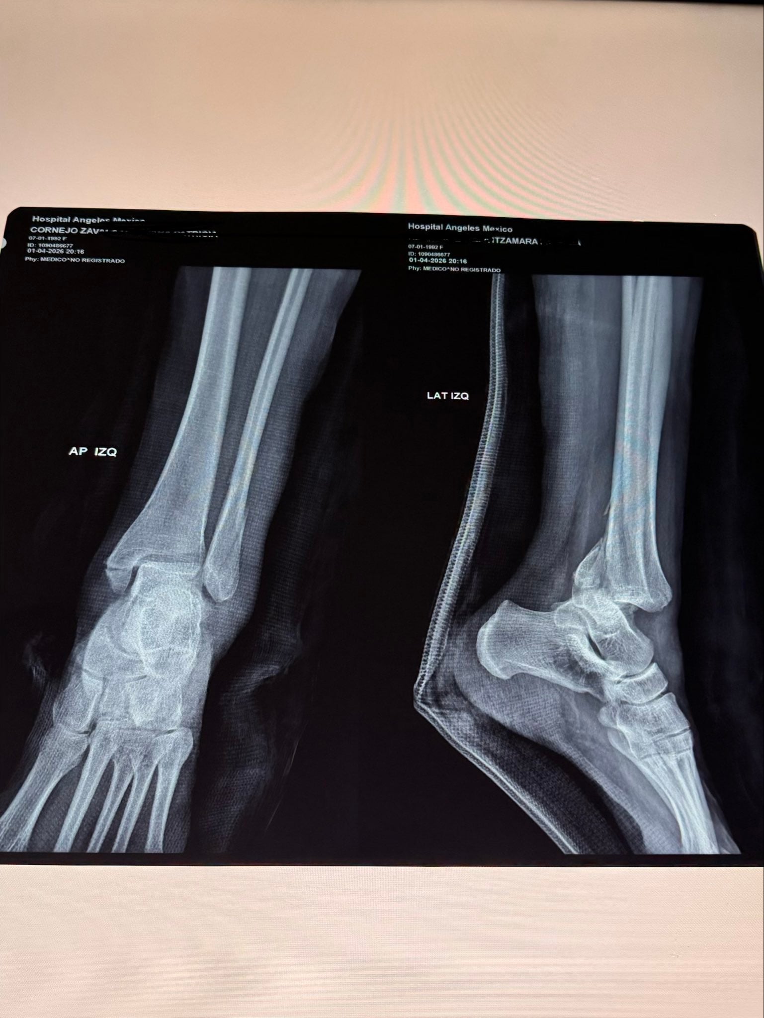 Madre muestra la fractura que le causó un juego infanil en Perisur.